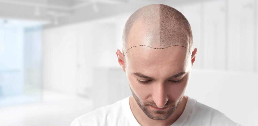 A Hair Transplant Journey