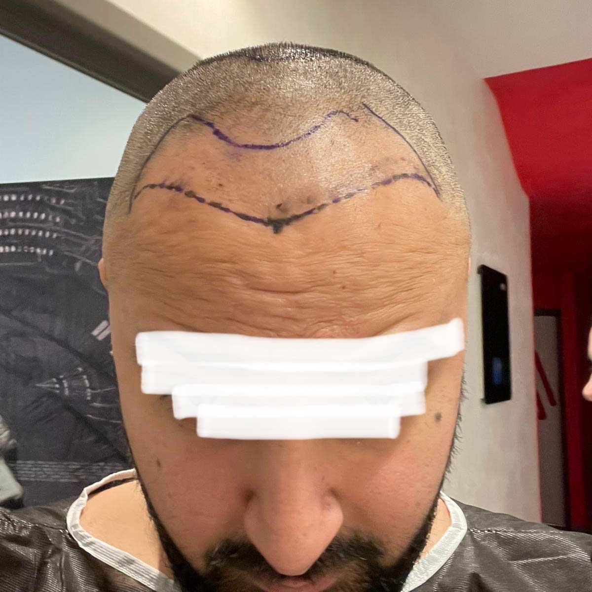 Blog-Hairline